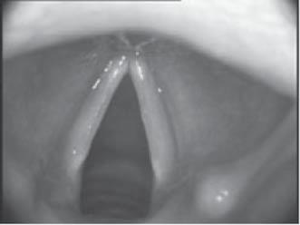 Sound recordings: acoustic and articulatory data 189 Figure 9.11. Pictures of abducted (left) and adducted (right) vocal folds, taken via flexible endoscope http://www.voicedoctor.