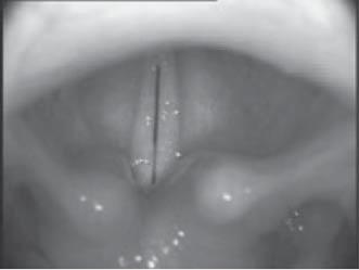 With a rigid endoscope, the camera is at the end of a rigid tube that is held toward the back of the mouth, with the camera pointing downward to image the larynx.