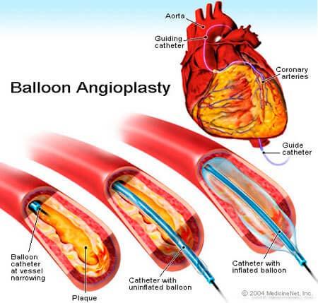 Door-to-balloon time = from the moment a heart attack patient arrives in