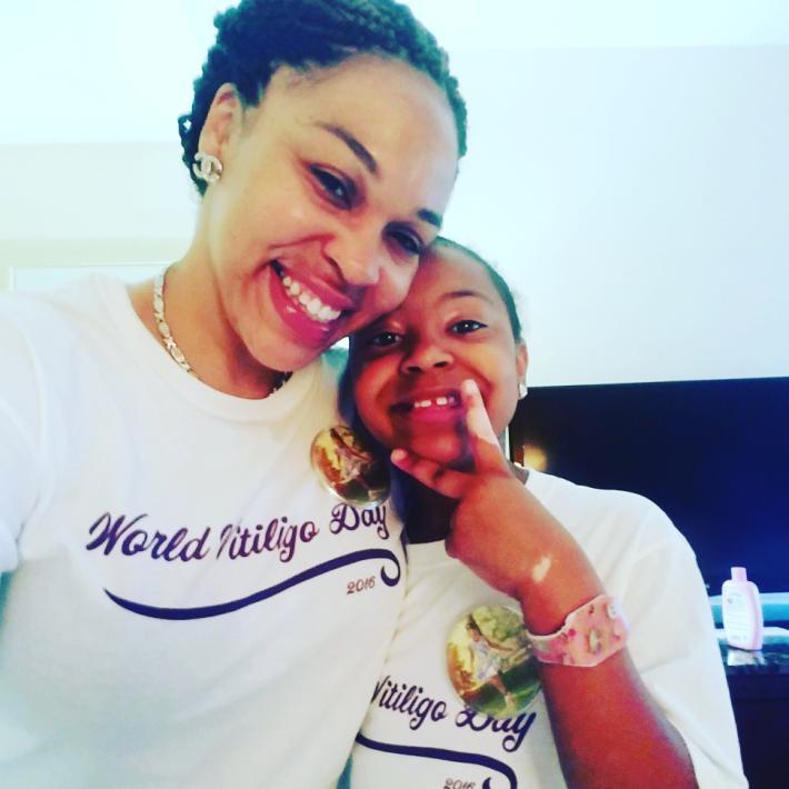 My Vitiligo Story My name is Crainysha Rutherford, and my daughter Khori Symone Muckle has Vitiligo. Vitiligo is a skin disorder in which various white patches appear on different parts of the body.