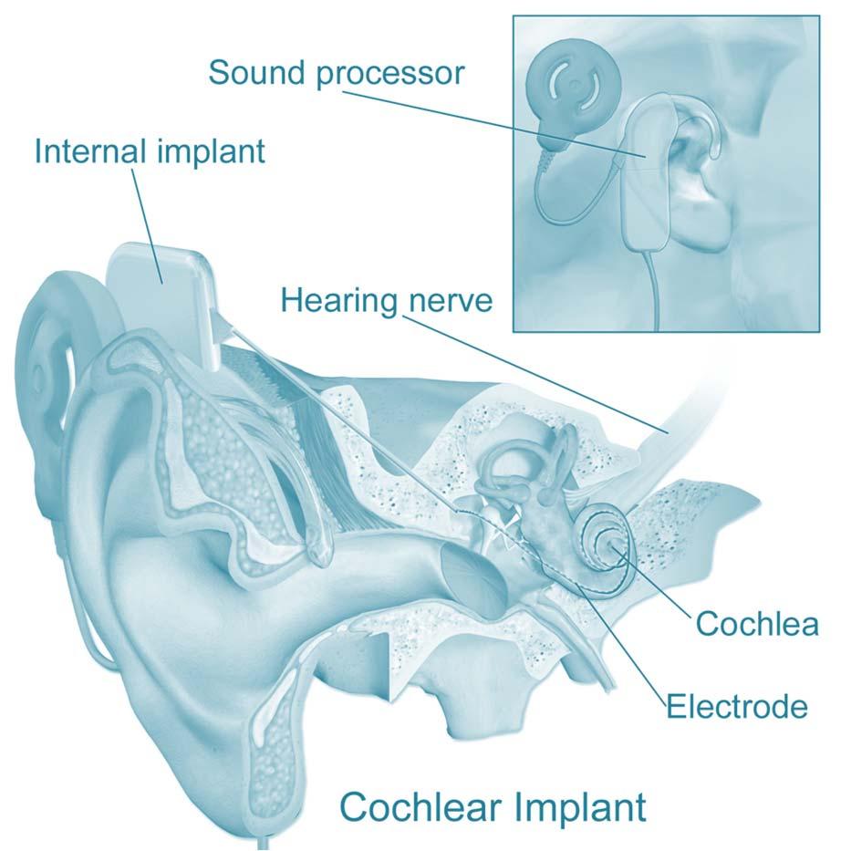 Audiology TRENDS Unbundling of services Direct-to-consumer hearing tests and