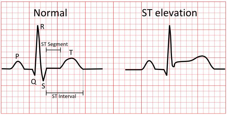 An Example Many patients with 4 features each Heart rate in beats per minute Number of past heart attacks Age ST elevation (binary) Outcome (death) based on features