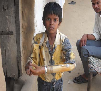 Roshan is a 7 year old, student in the Ambedkar School. He did not have a left hand since birth. He faced a lot of riducle from his peers about his missing limb.