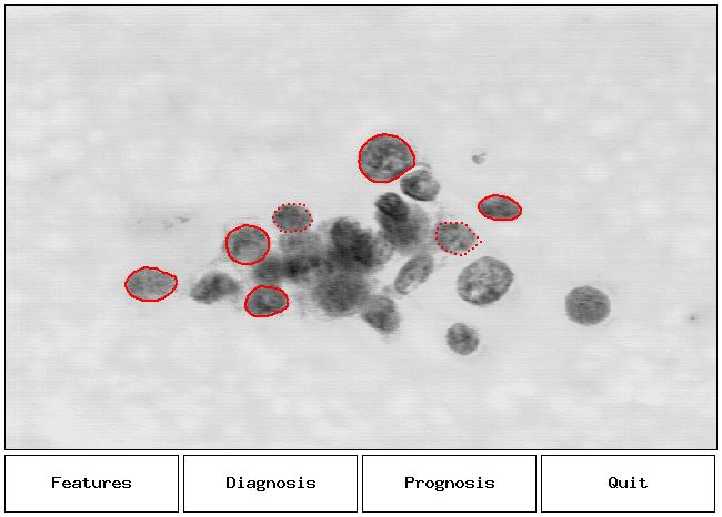 Today: Introduction to Supervised Learning Cell Nuclei of Fine Needle Aspirate Cell samples were taken from tumors in breast cancer patients before surgery, and imaged Tumors were excised