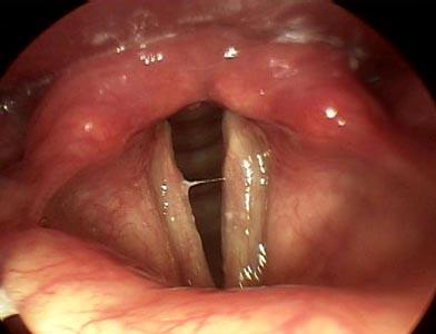 State of the vocal cords Adjustments of the glottis