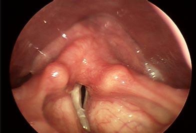 State of the vocal cords cont. 2) Narrow glottis: i.e. held gently together The air from the lungs forces its way through them causing the folds to vibrate.