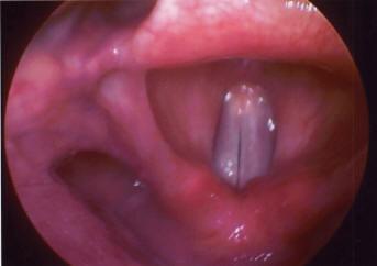 State of the vocal cords cont. 3) Closed glottis, i.e. vocal folds are firmly pressed together.