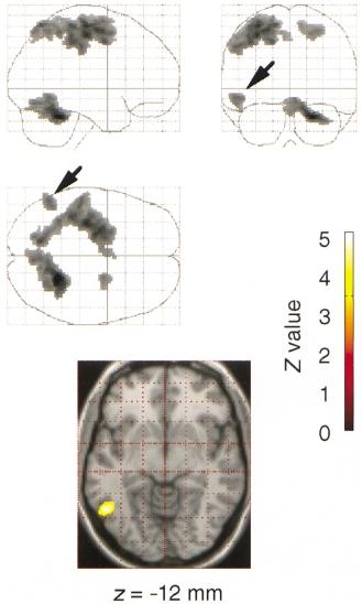 964 K. Nakamura et al. Fig. 6 Unilateral activation of the left PITC (arrow). The figure illustrates SPM{Z}, where transcription mental recall is compared with oral reading semantic judgement.