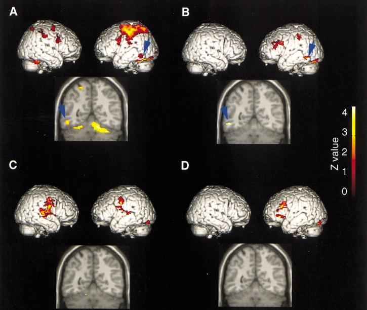 Posterior temporal activation in writing 961 Fig. 5 Brain areas activated in the four tasks (group analysis). The left side of the coronal image corresponds to the left side of the brain.