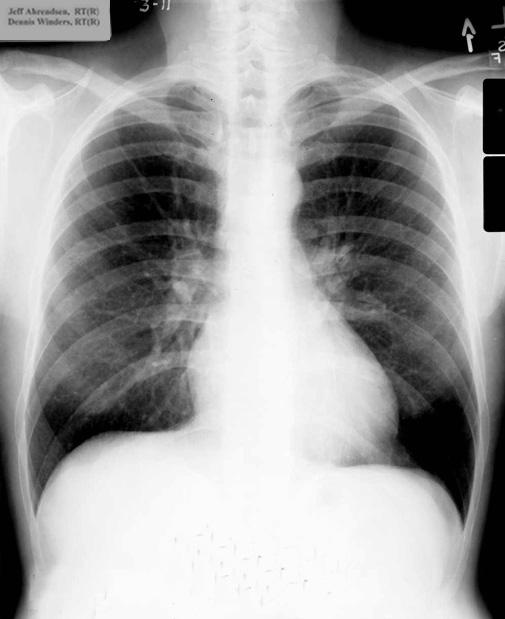 Routine chest x-ray, which students perform within the first six weeks of the
