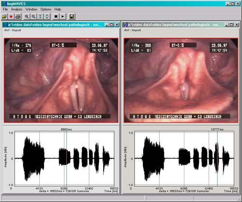 Video of glottis and speech signal in