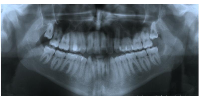 Sharon Orton-Gibbs 3mm mandibular reduction & correction of