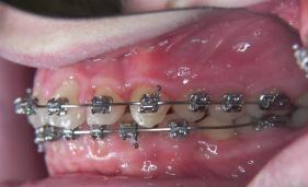 molar correction