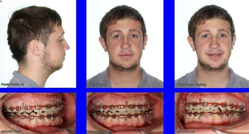 5 days post orthognathic surgery (9 months into treatment & 2