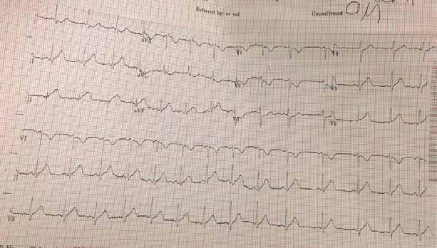 EKG Posterior MI Megan Boissonneault, EKG Selective Clinical Scenario: Patient is a 54-year-old M with a history remarkable for hypertension who presented to the Emergency Department for one day of