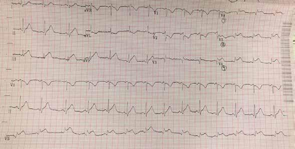 Take Home Points: Keep posterior MI on your chest pain differential and every time you look at an EKG Get the posterior EKG quickly when suspicious Posterior MI is an indication for emergent cath; so