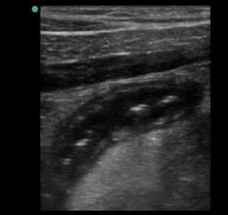 The combination of PAS with ultrasound imaging for appendicitis has several benefits.