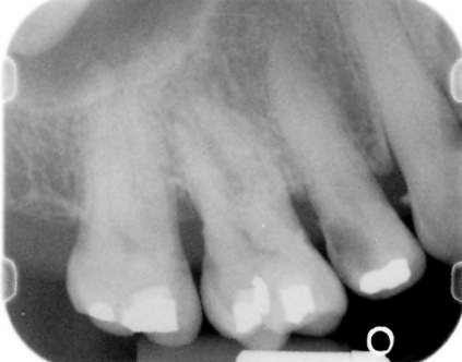 Drag and Drop New Option This is a periapical radiograph of maxillary molars and premolars.