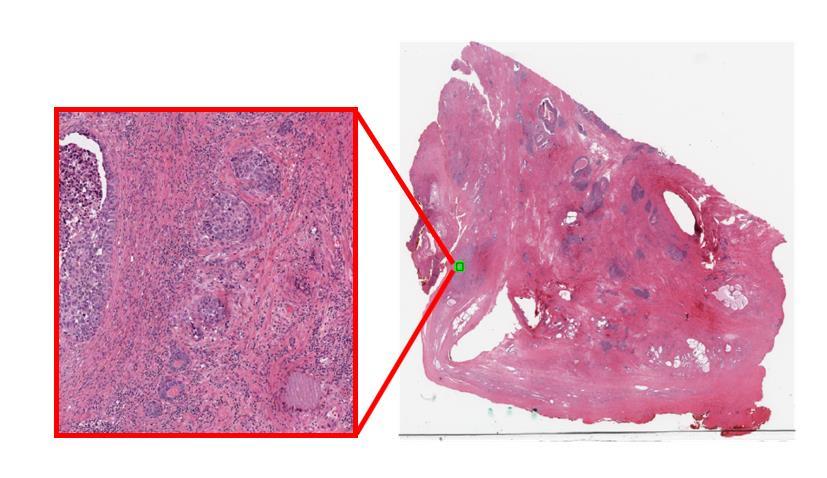 Example Application: Automate detection of relevant findings Pattern detection approaches have been successfully applied to detect regions of interest in digital pathology slides, and