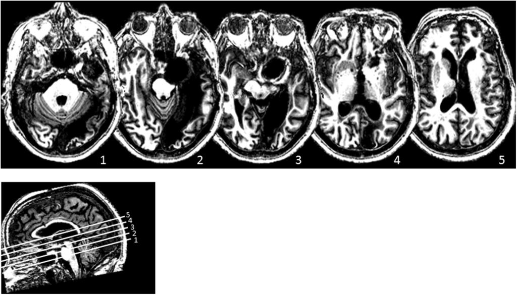 LETTER AND DIGIT IDENTIFICATION Figure 1. Magnetic resonance imaging (MRI) displaying L.H.D. s lesion. Horizontal images are parallel to the anterior commissure (AC) posterior commissure (PC) line.