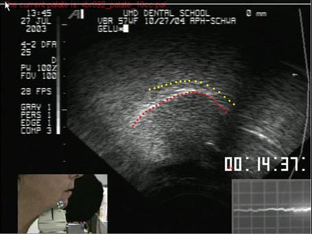 Figure 4-6. Automatically tracked contour The contour is superimposed on mid-sagittal ultrasound image of the beginning of the release of /g/.