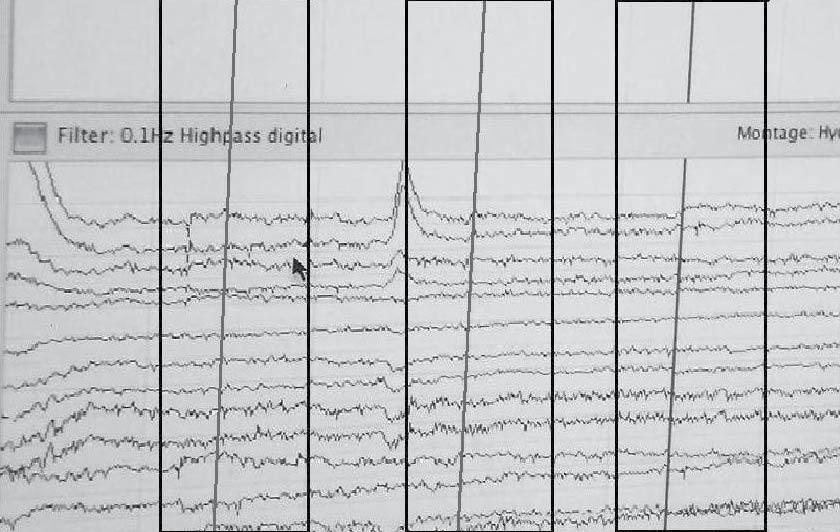 Translational Display of Neurophysiologic Investigations in Communication Sciences and Disorders 271 Segment before and after pa was presented Segment before and after pa was presented Segment before